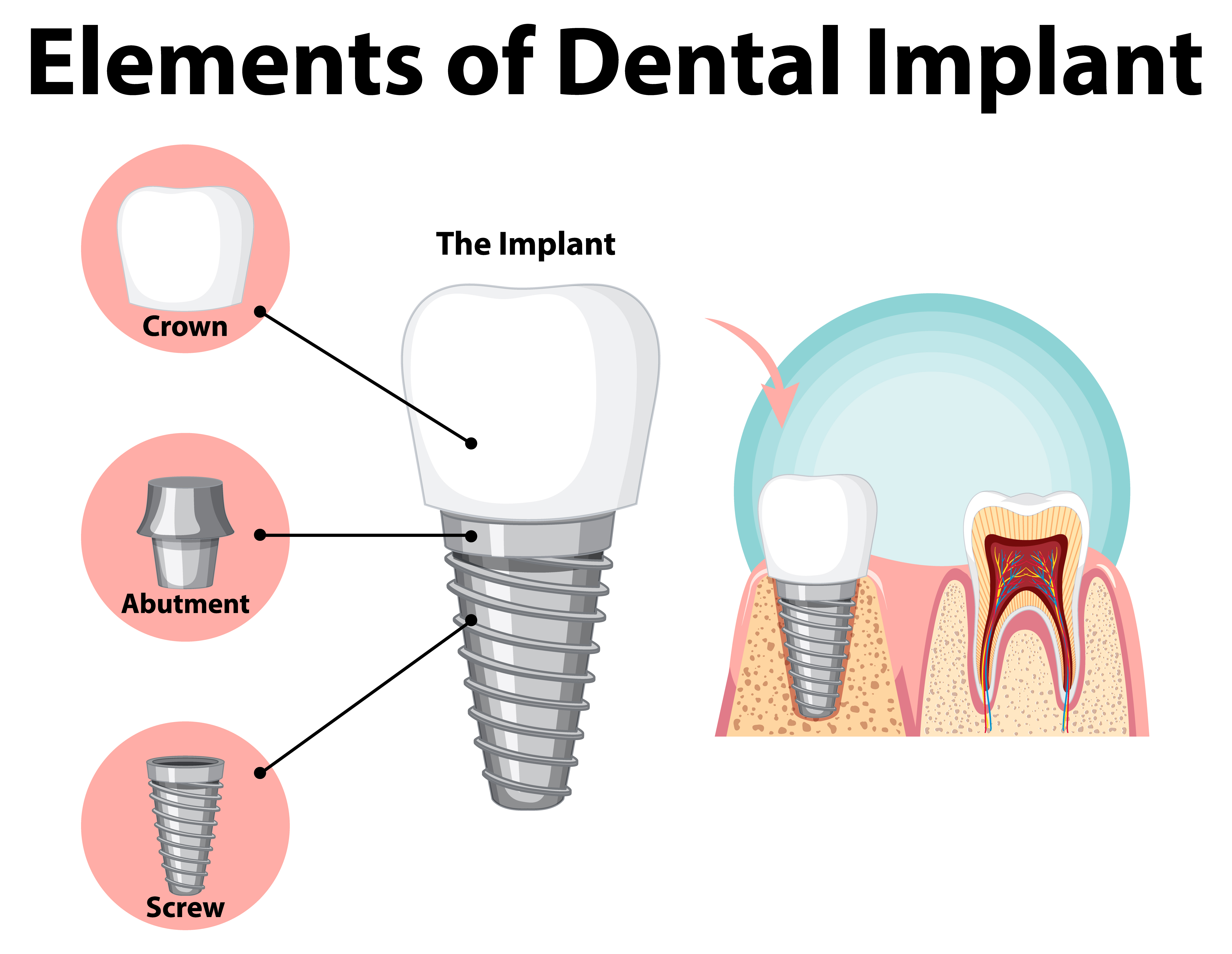 Dental-Implants-300x240